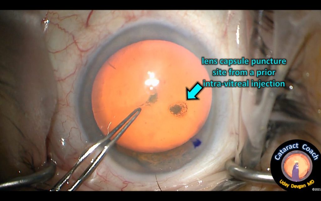 Cataract Surgery after lens trauma from Intravitreal