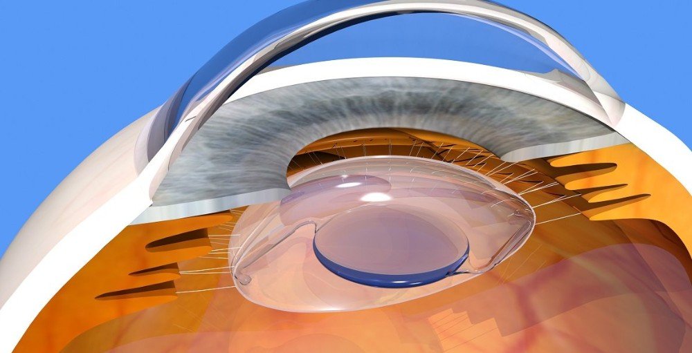 Intraolcular Lens Implants Gregory Cox. M.D. Eye