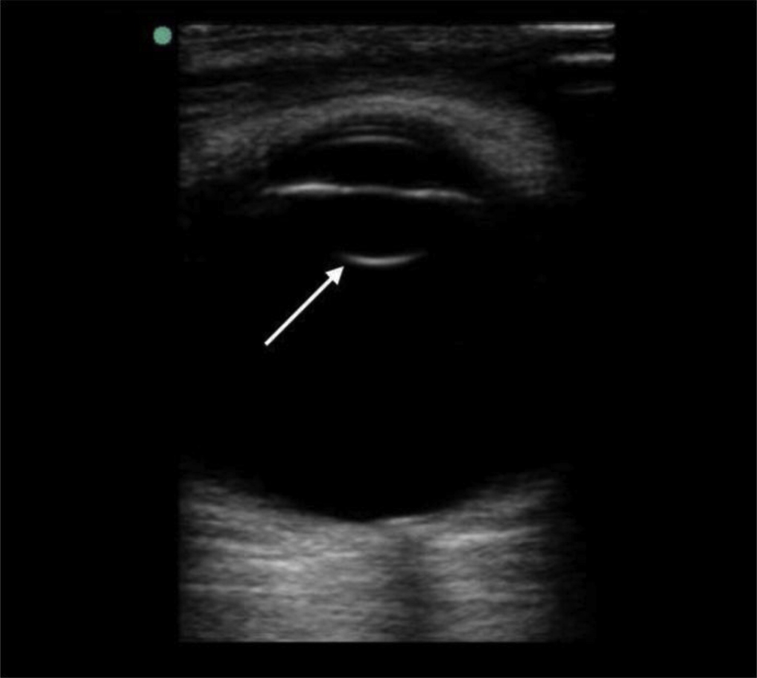 TraumaInduced Bilateral Ectopia Lentis Diagnosed with