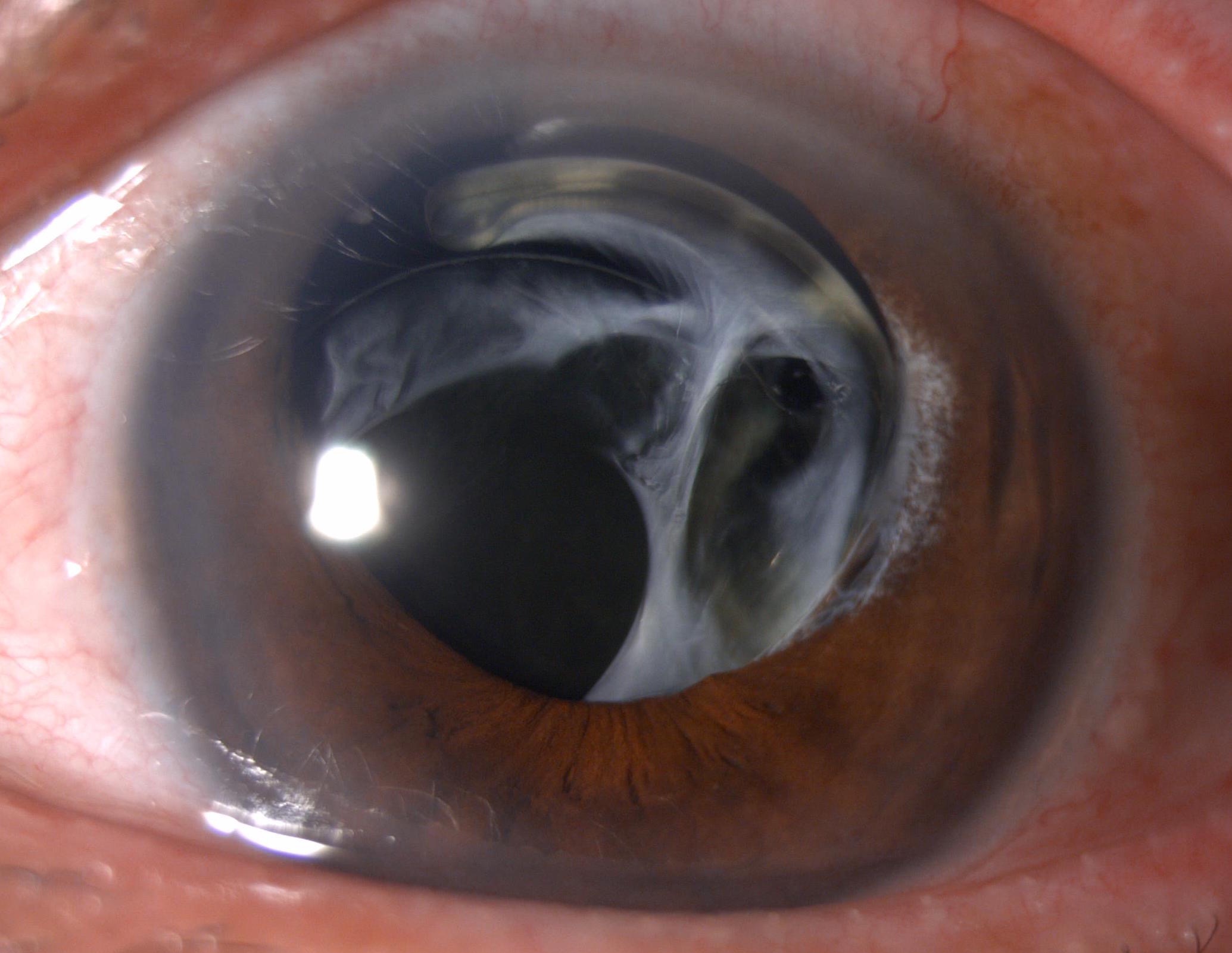 Dislocated Posterior Chamber Intraocular Lens (PCIOL) in