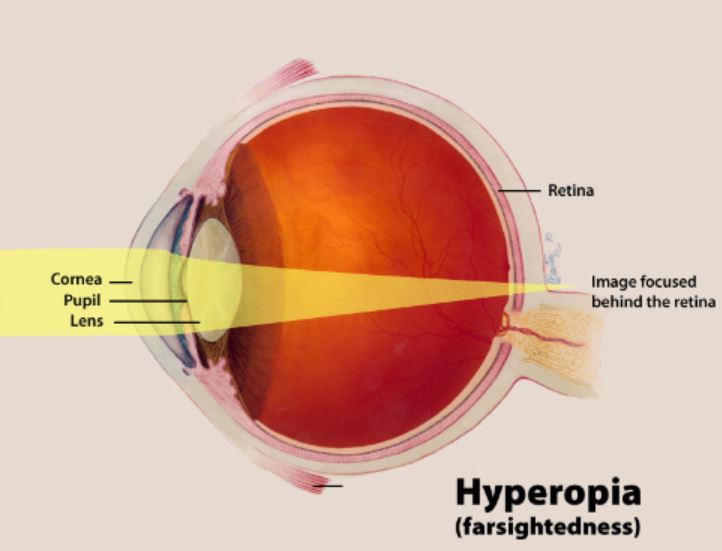 Refractive Lens Exchange Vision Correction Las Vegas