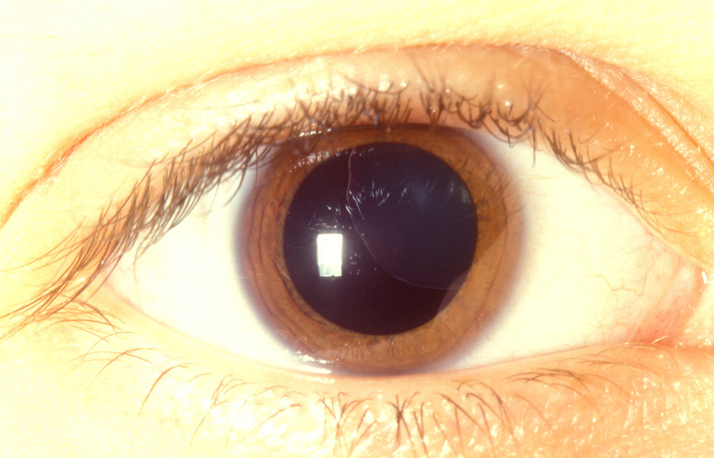 Dislocated lens in Marfans syndrome. © Clare Gilbert