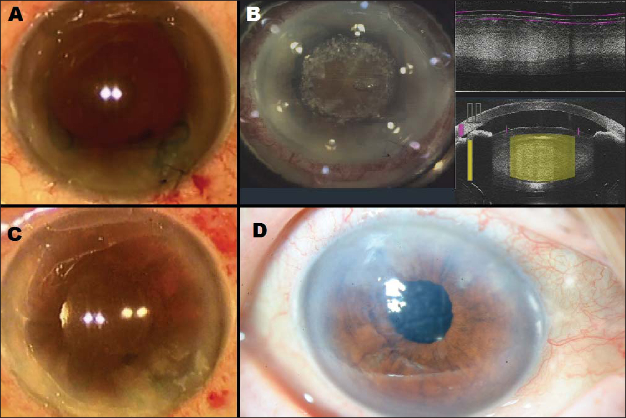 Femtosecond LaserAssisted Cataract Surgery in Management