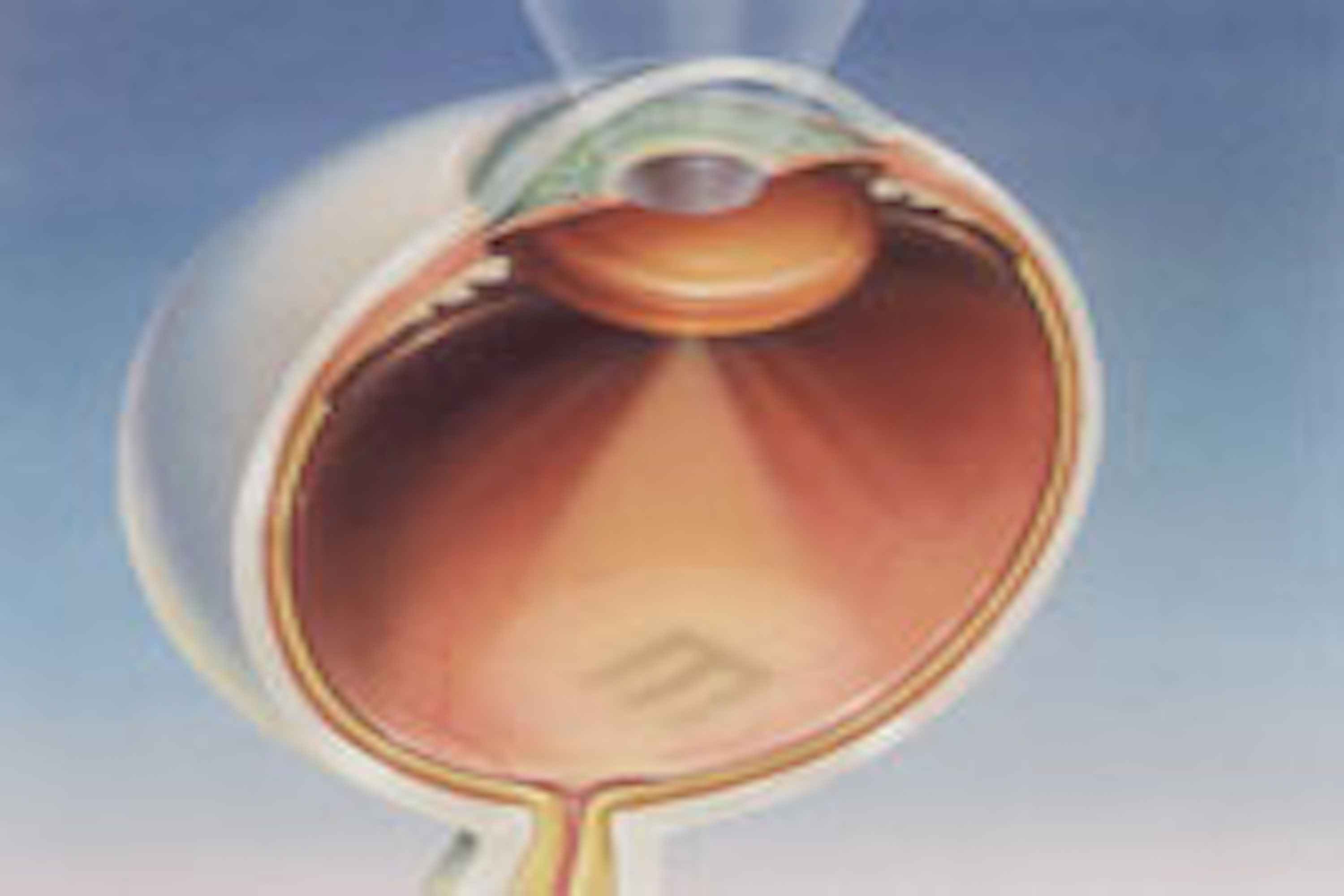 Cataract