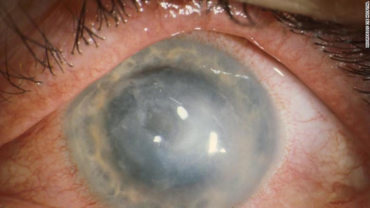 Ongoing outbreak of rare eye infection found among contact