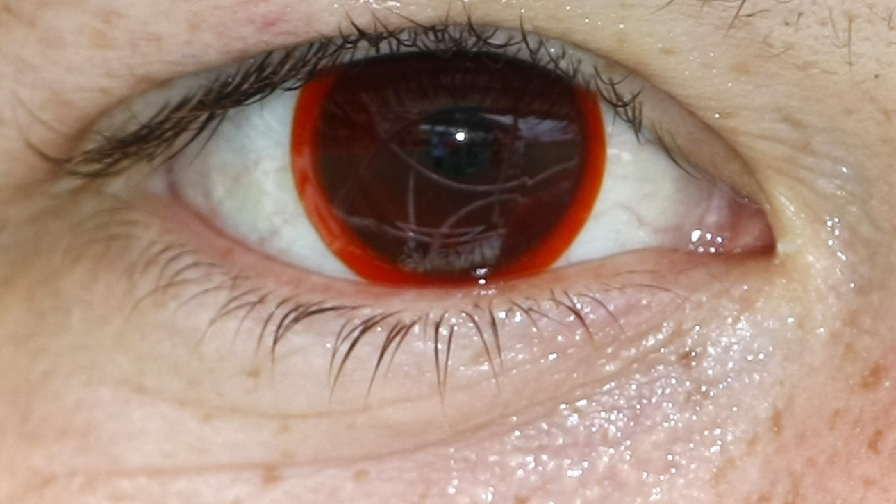 How Contact Lenses Grow Skin Bacteria In Your Eyes Vocativ
