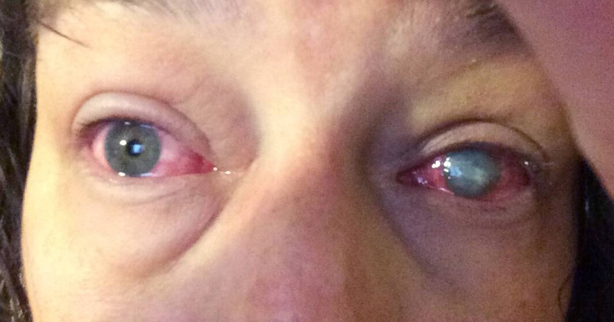 Can you swim in contact lenses? Doctors warn about infection