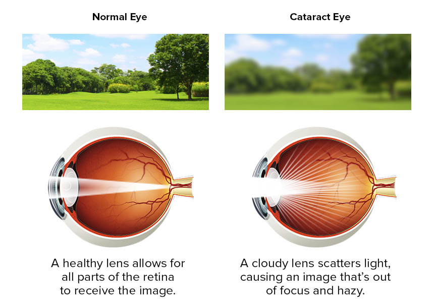 Cataract Evaluation Optometrist in Brunswick. GA