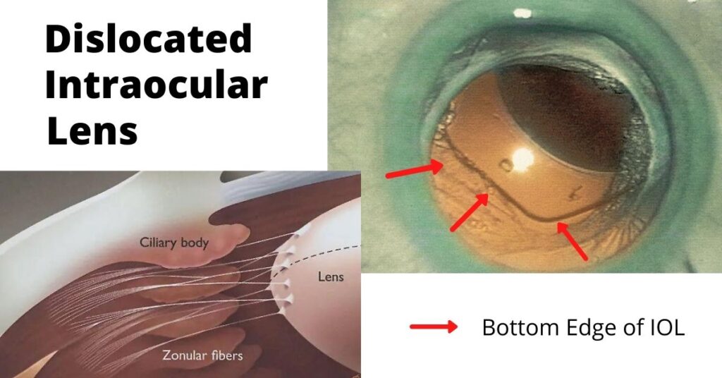 Dislocated Intraocular Lens Nader Moinfar. M.D.. M.P.H