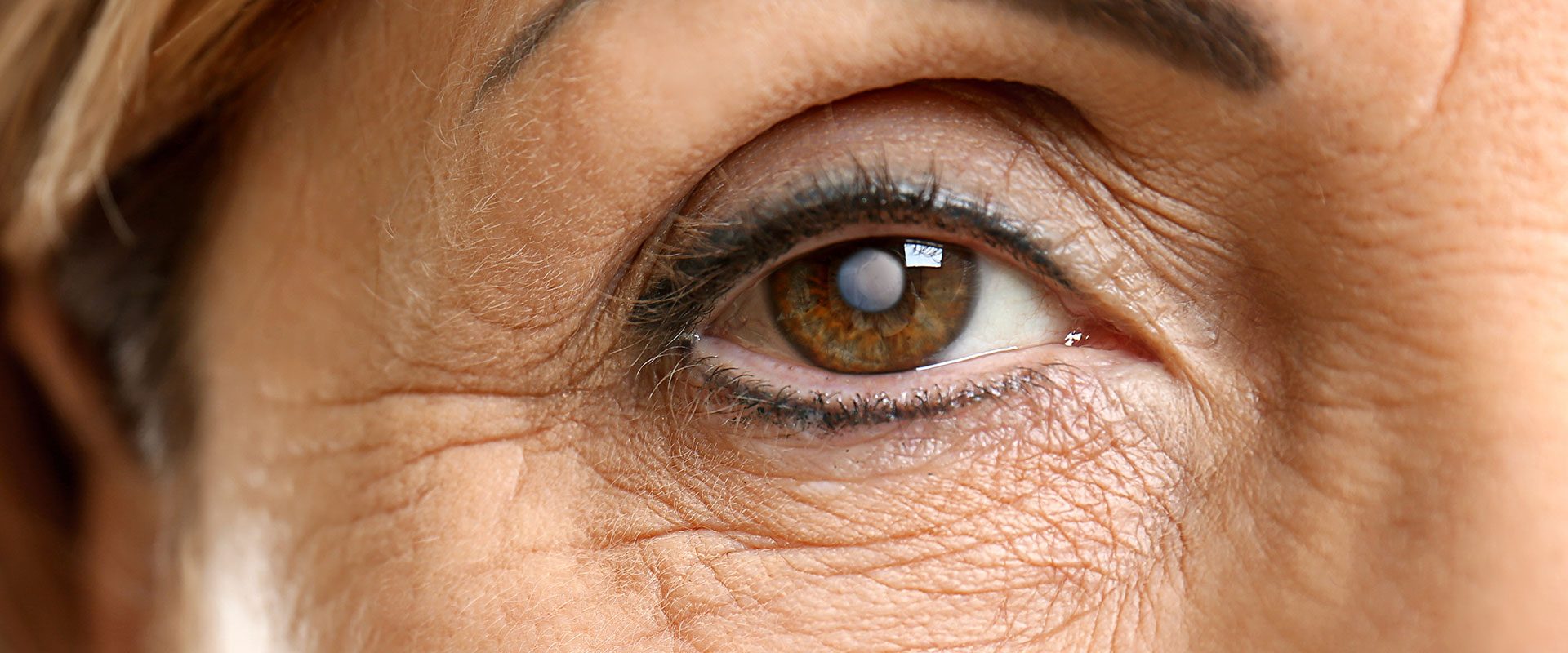 Cataracts Causes Symptoms Common Eye Problems