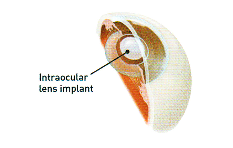 Cataract Surgery Peregrine Eye and Laser Institute