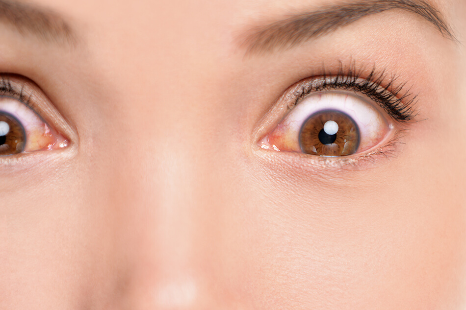 Everything you need to know about a contact lens eye