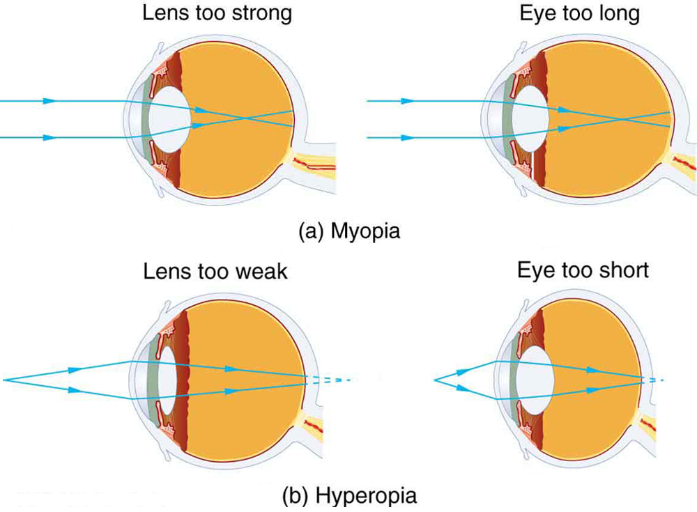 Vision Correction · Physics