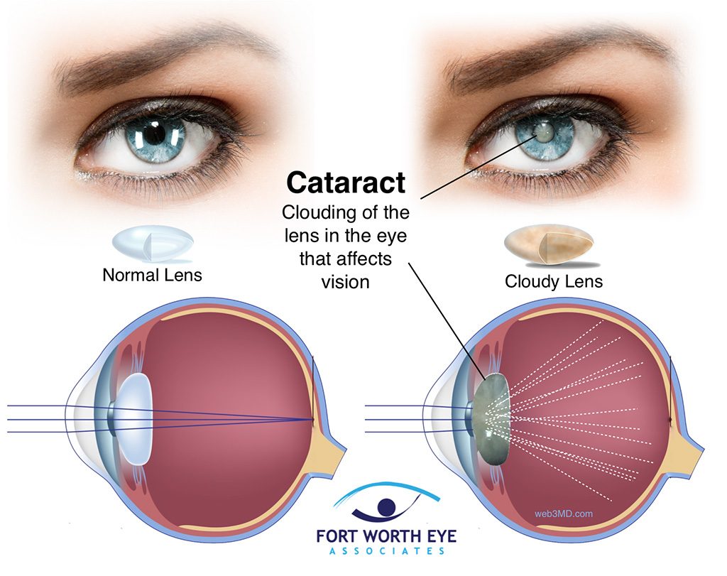 Cataract Surgery Procedure Safety. Recovery. and Effects