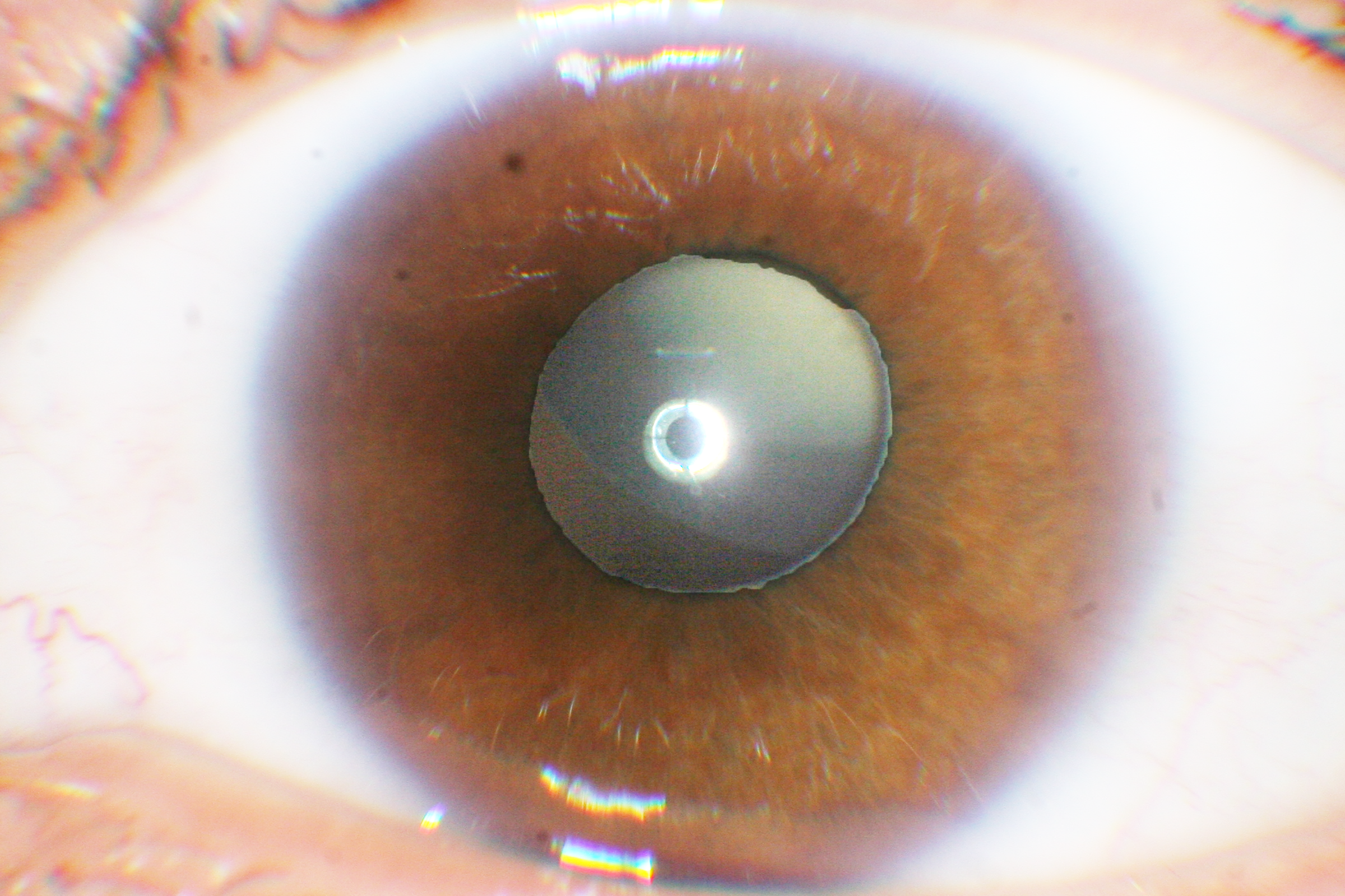 Ectopia Lentis Marfans Syndrome Cataract Ectopia