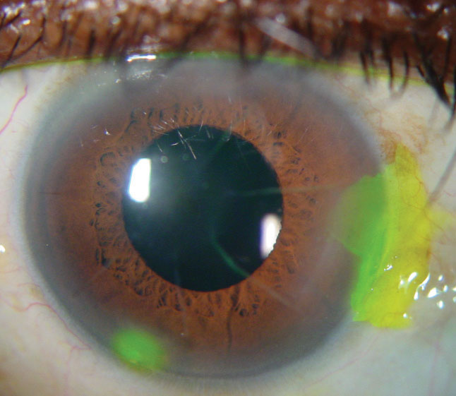 Refractive Surprises What To Do Next