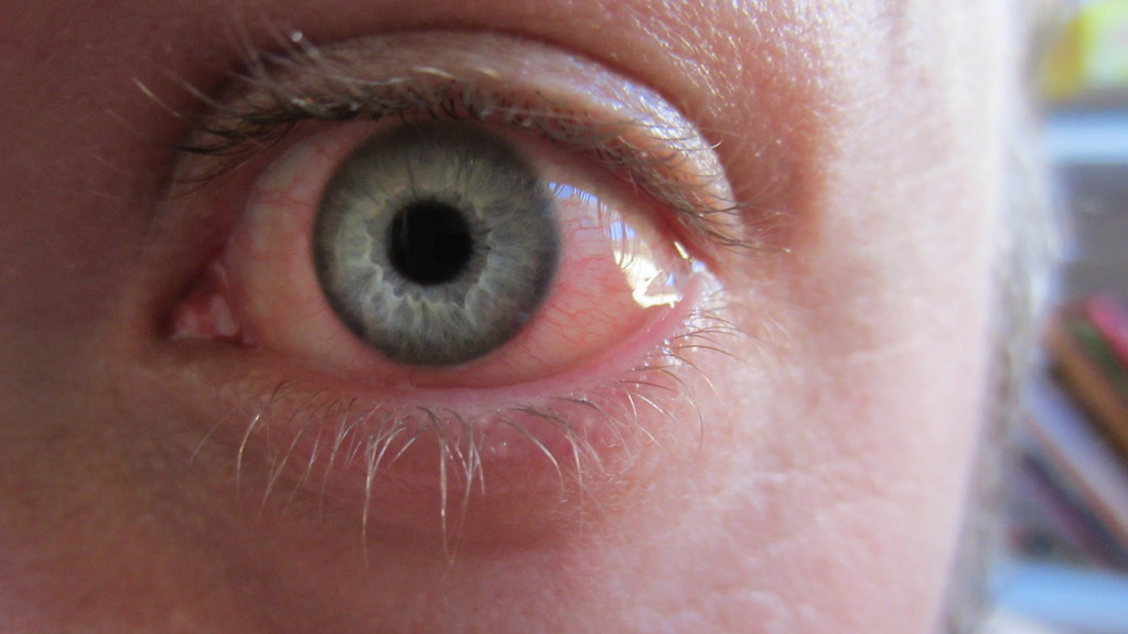Causes of Eye Irritation