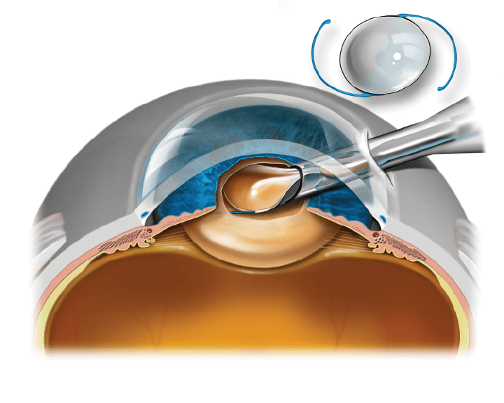 Cataract Surgery Stahl Vision