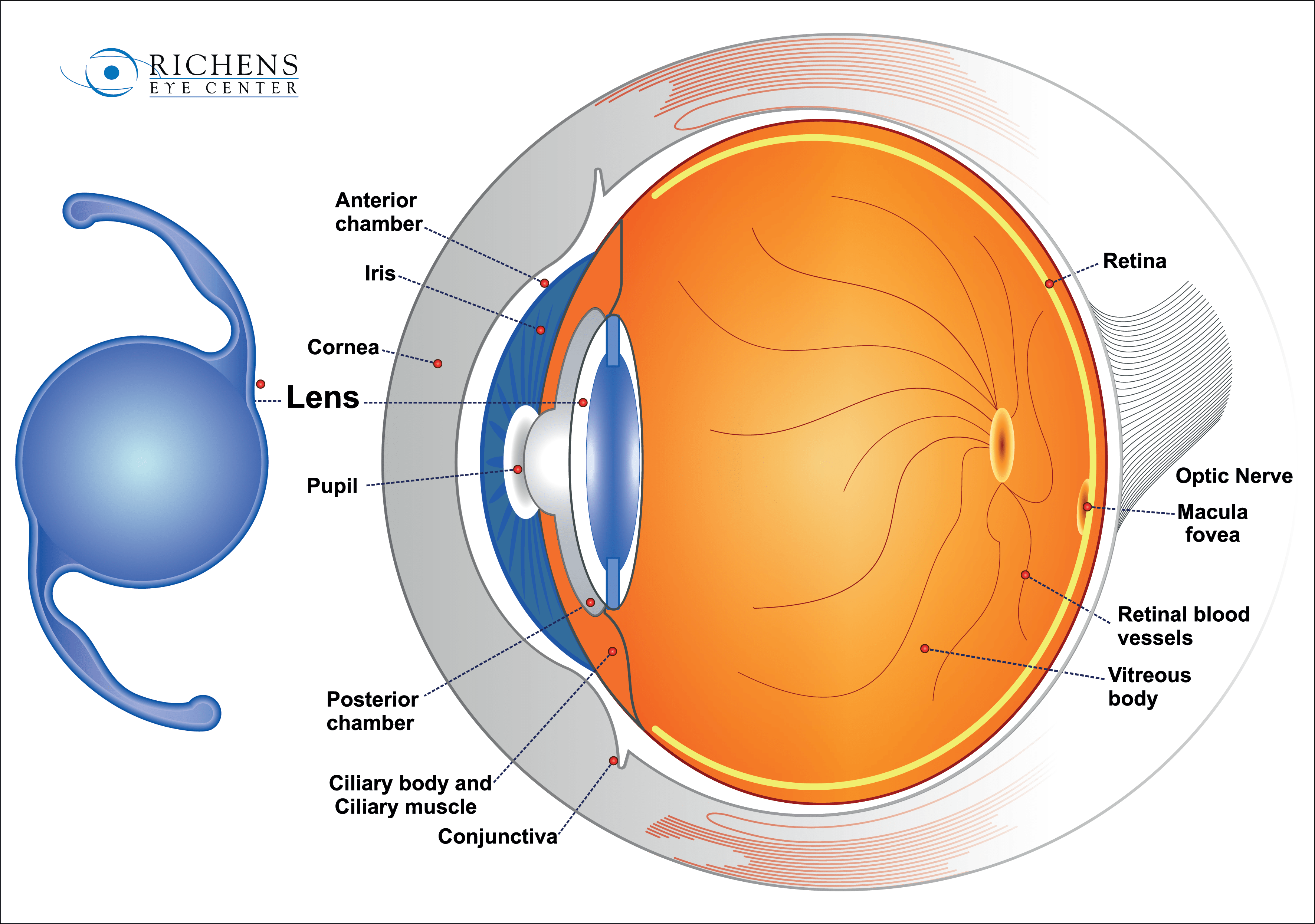 Richens Eye Center offers a closer look at cataract
