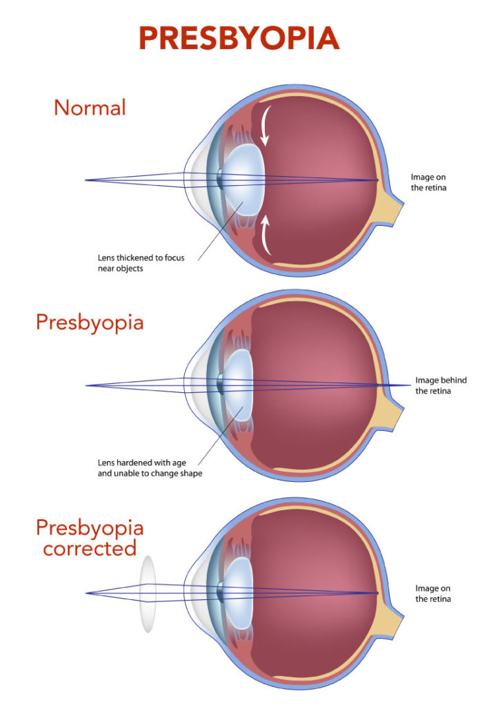Refractive Lens Exchange Saint James Eye Clinic