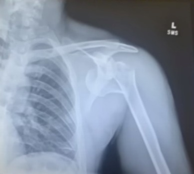 He spent months in hospital and still suffered nerve damage from the attack