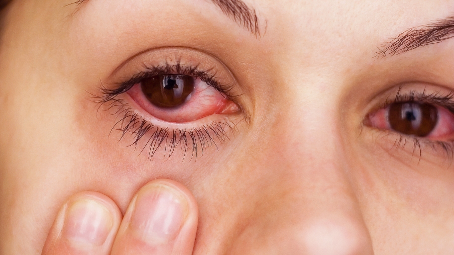 Ultimate Guide on How To Get Rid Of Pink Eye!