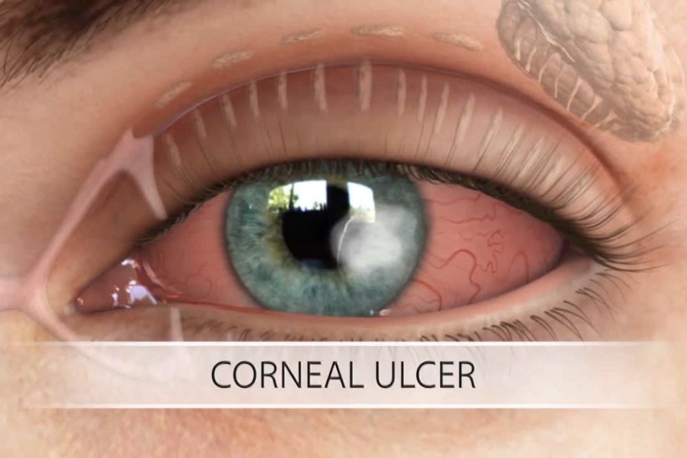 Corneal Ulcer (Keratitis) Causes and Treatment The Eye News