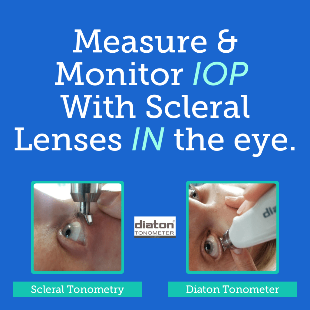 Innovative Scleral Tonometer DIATON Featured at SECO