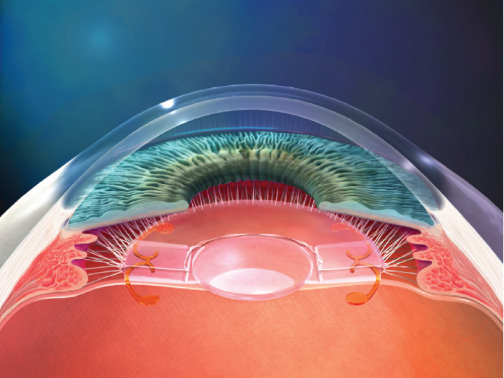 TriState Eye Crystalens