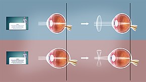 Refractive error Wikipedia