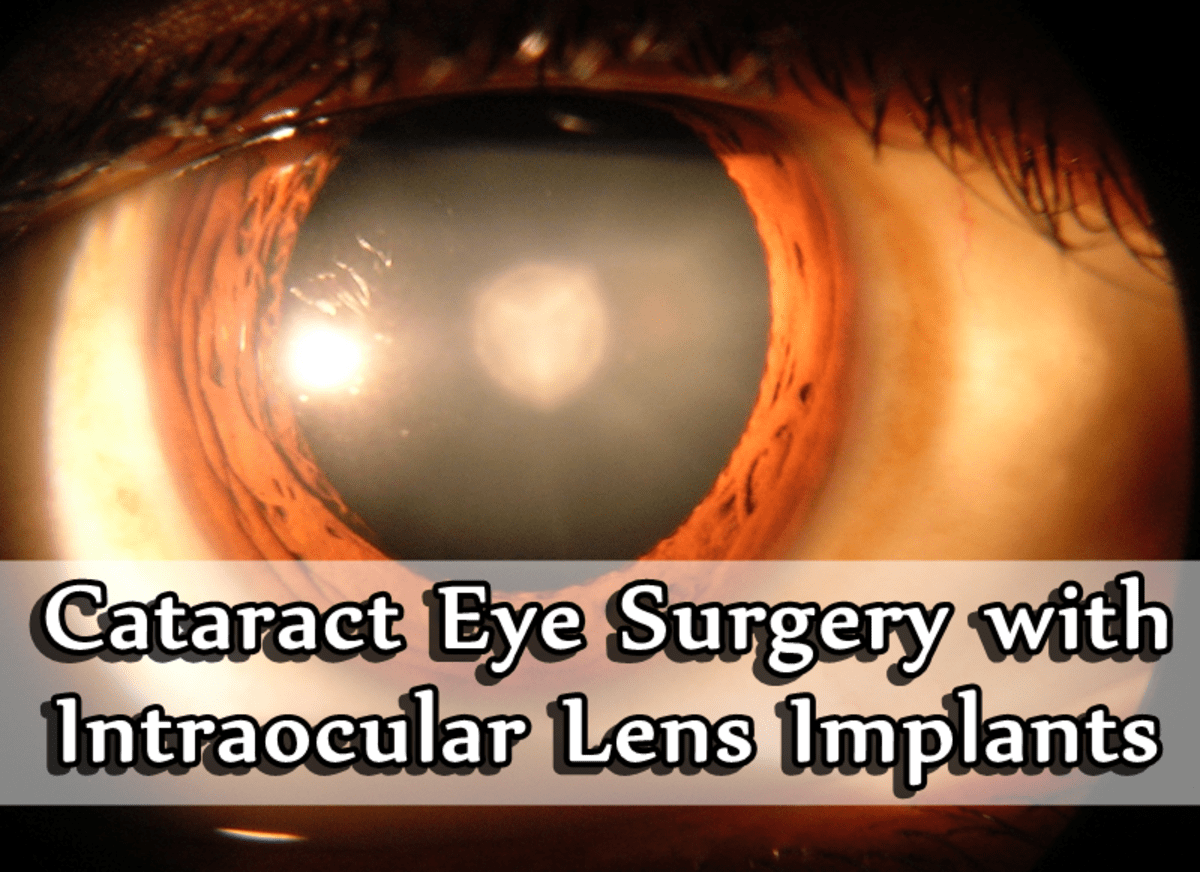 Cataract Eye Surgery With Intraocular Lens Implants HealDove