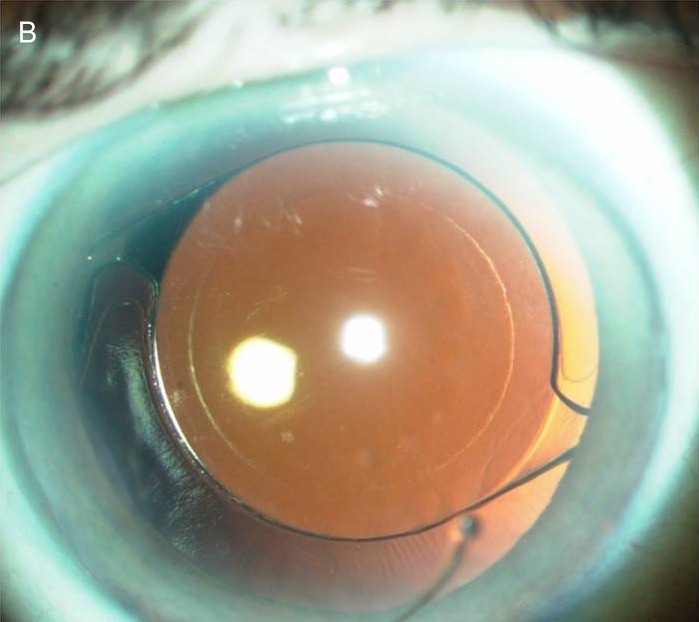 Refractive Lens Exchange Valerie Saw