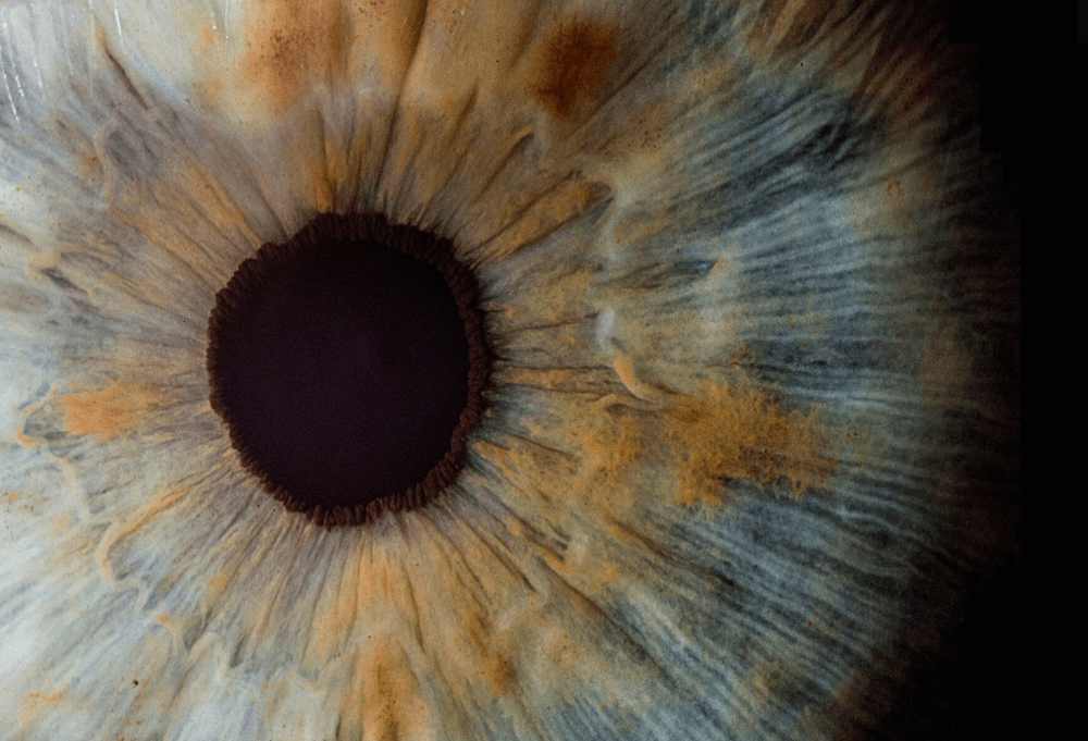 Eye Surgery Treatments inc Laser Eye Surgery. Lens