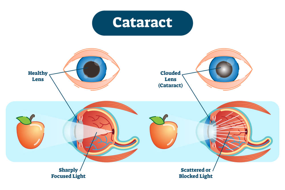 Cataract Surgery in Delhi Best Surgeons. Lens Cost