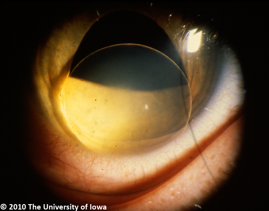 Marfan Syndrome. Ophthalmology The