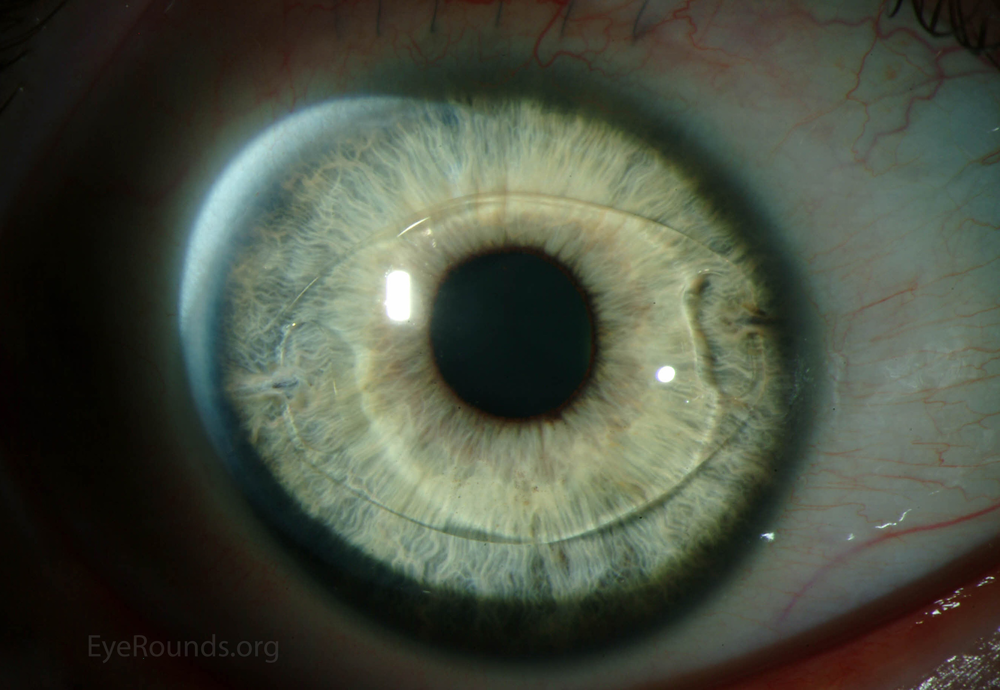 Verisyse phakic intraocular lens implant for high myopia