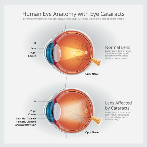 Cataract DefinitionWhat Are Cataracts What are the