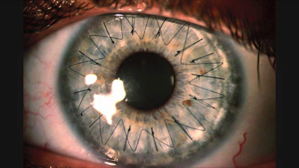 Post Graft Contact lenses corneal transplant Westmead