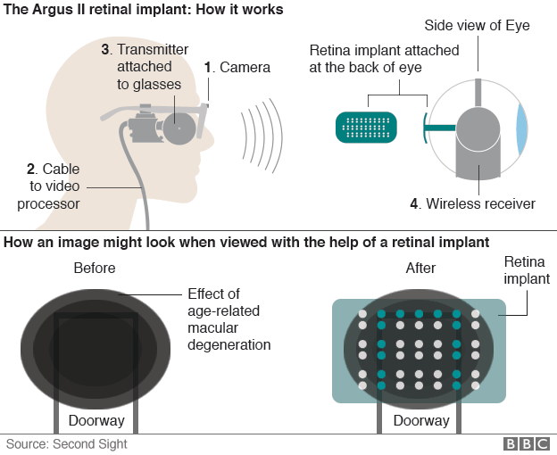 A Treatment for Blindness? NHS to Install Bionic Eyes in
