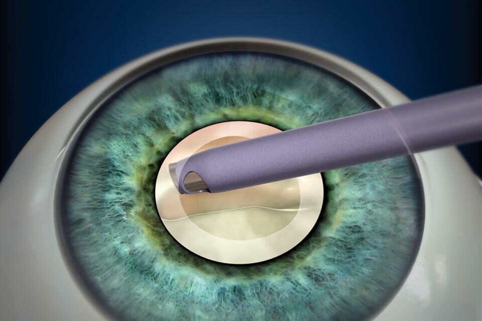 Cataracts ZIEN